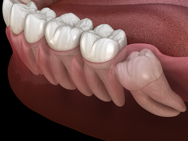 Wisdom Teeth Procedure Chicago