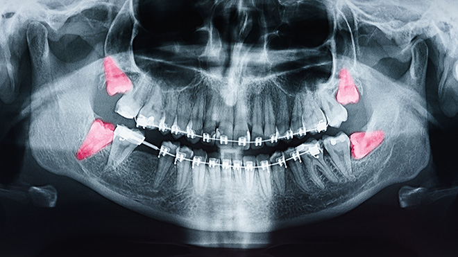 Wisdom Teeth Procedure Chicago